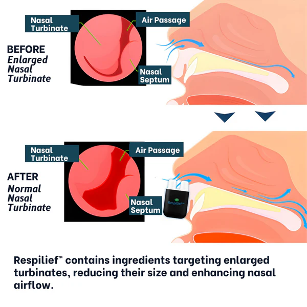 Respilief™ Nasal Therapy Inhaler