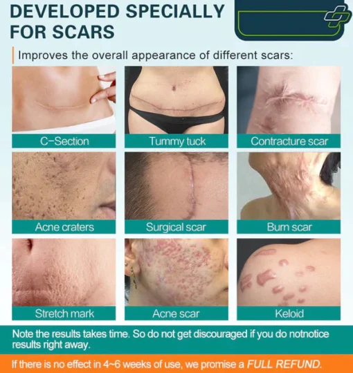 SCARGone™ Advanced Scar Spray