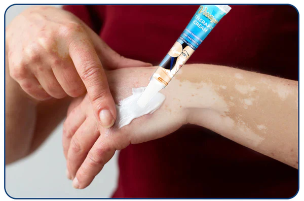 SEURICO™ Vitiligo Therapy Cream