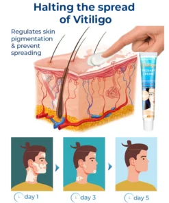 SEURICO™ Vitiligo Therapy Cream