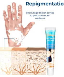 SEURICO™ Vitiligo Therapy Cream