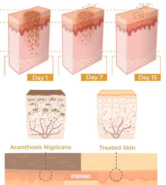 Seurico™ Acanthosis Nigricans Hyperpigmentation Therapy Cream