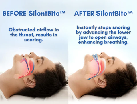 SilentBite™ Anti-Snoring Mouthpiece