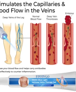 Fivfivgo™ 415NM Blaulicht-Krampfadern-Therapie-Set