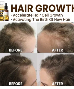 LIMETOW™ Anti-Hair Loss Treatment Essence