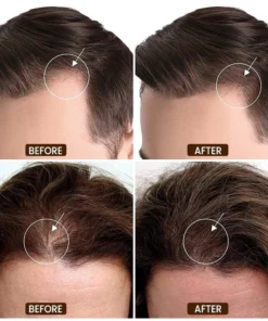 LIMETOW™ Anti-Hair Loss Treatment Essence