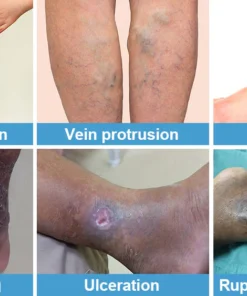 Nurbini™ Varicose Veins Treatment Cream