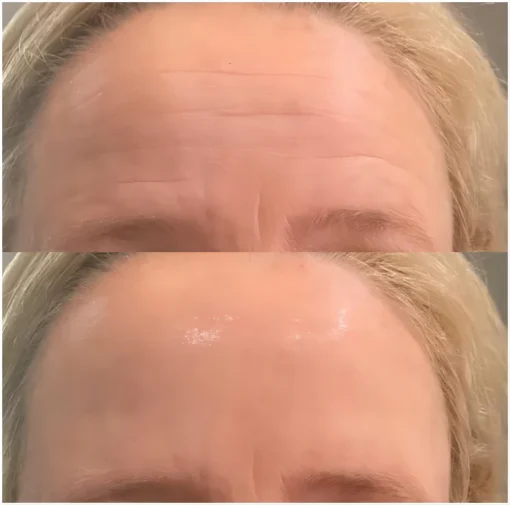 SkinRevive™ Facial Botox Serum