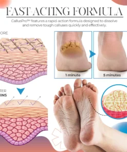 CallusPro™Calluses Remove Cream