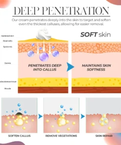 CallusPro™Calluses Remove Cream