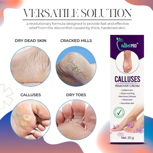 CallusPro™Calluses Remove Cream