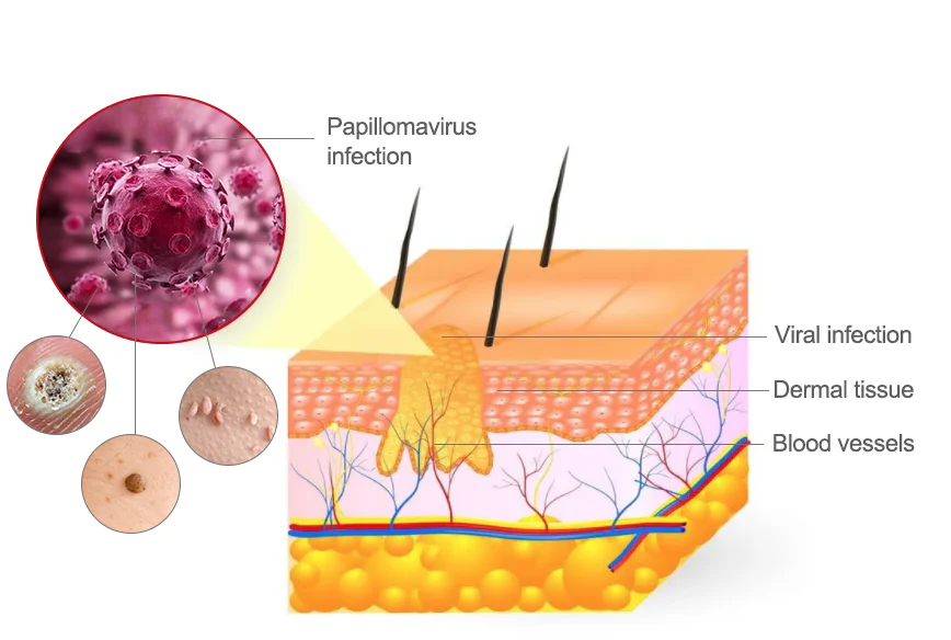 LOVILDS™ 𝐁𝐞𝐞 𝐕𝐞𝐧𝐨𝐦 𝐌𝐨𝐥𝐞 𝐚𝐧𝐝 𝐖𝐚𝐫𝐭 𝐓𝐫𝐞𝐚𝐭𝐦𝐞𝐧𝐭 𝐂𝐫𝐞𝐚𝐦