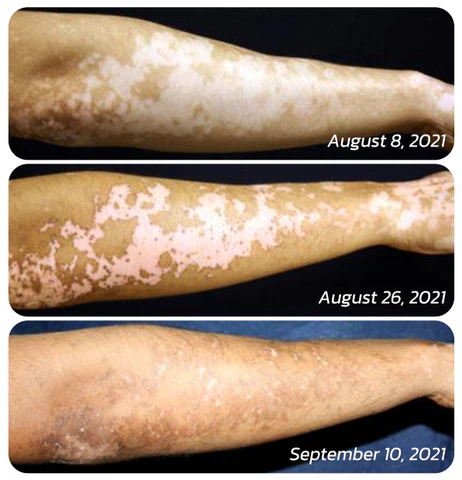 Seurico™ TreatVitiligo Soothing Cream