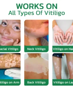 Seurico™ TreatVitiligo Soothing Cream