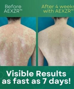 AEXZR™ Psoriasis Cream