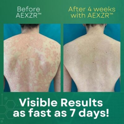 AEXZR™ Psoriasis Cream