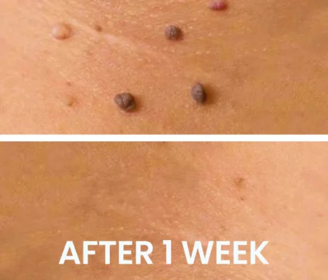 AEXZR™ Scyphozoa Skin Tags Solution