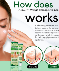 AEXZR™ Vitiligo Therapeutic Cream