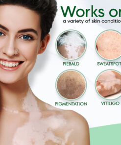 AEXZR™ Vitiligo Therapeutic Cream