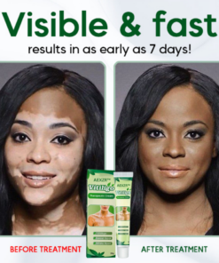 AEXZR™ Vitiligo Therapeutic Cream