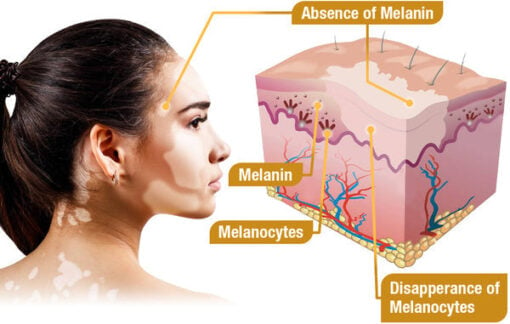 BEEVENOM VITILIGO TREATMENT CREAM