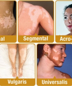 BEEVENOM VITILIGO TREATMENT CREAM