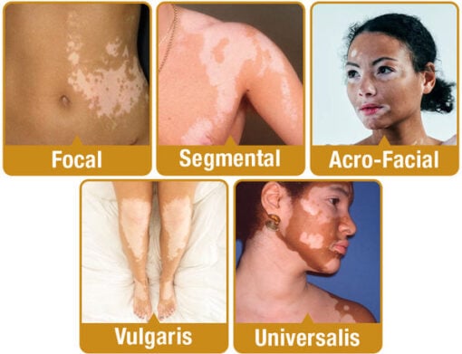 BEEVENOM VITILIGO TREATMENT CREAM