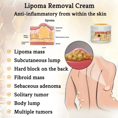 Bee Venom Lipoma Removal Cream