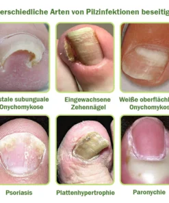 Furzero™ Nagelverteidigung Bienengift-Behandlungsserum