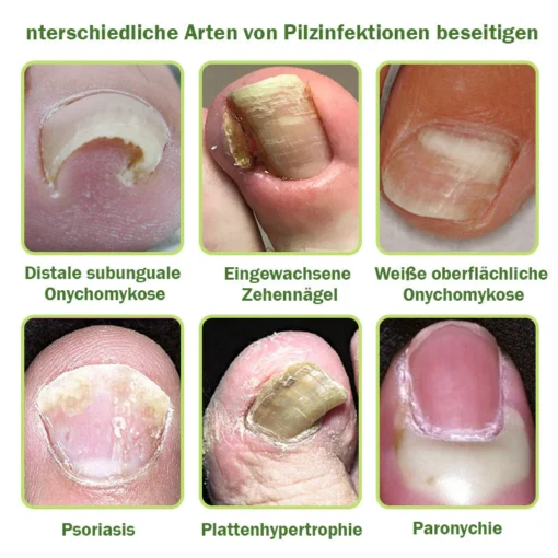 Furzero™ Nagelverteidigung Bienengift-Behandlungsserum