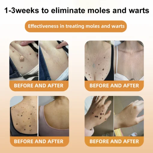 LOVILDS™ Bee Venom Mole and Wart Treatment Cream