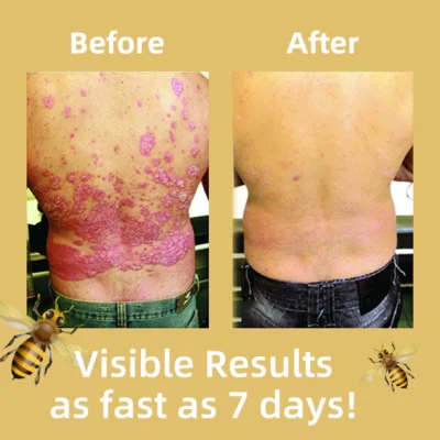 Lotmay™ Bee Venom & Ocean Psoriasis Healing Cream