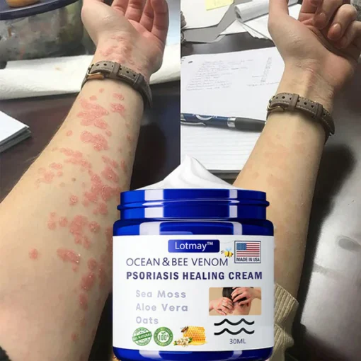 Lotmay™ Bee Venom & Ocean Psoriasis Healing Cream