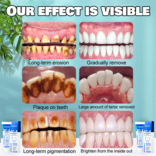 Unpree™ SP-4 Probiotic Whitening Toothpaste