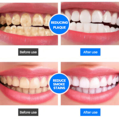 Unpree™ SP-4 Probiotic Whitening Toothpaste