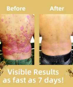 VolumElle™ Bee Venom & Ocean Psoriasis Healing Cream