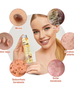 ZVLZVL™ Bee Venom Mole and Wart Treatment Spray