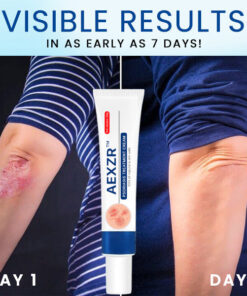 AEXZR™ Psoriasis Treatment Cream