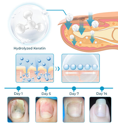 FLYCARE™ Arı Zəhəri Dırnaq Göbələkləri Müalicə Eliksiri