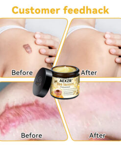 AEXZR™ Bee Venom Skin Treatment Cream