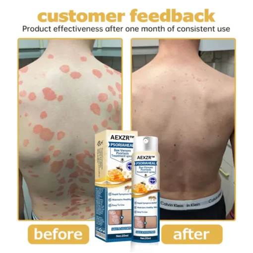 AEXZR™ PsoriaHeal Bee Venom Psoriasis Treatment Spray