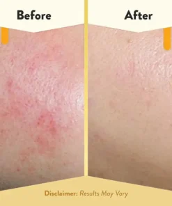 Honey Eczema Soothing Cream