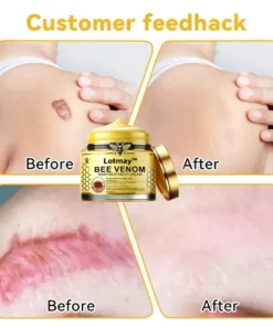 [Winter-Skincare] Lotmay™ Bee Venom Skin Treatment Cream（AAD RECOMMENDED）