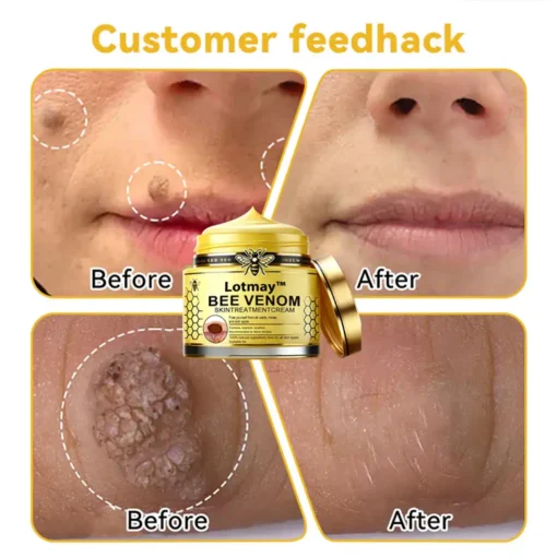 [Winter-Skincare] Lotmay™ Bee Venom Skin Treatment Cream（AAD RECOMMENDED）