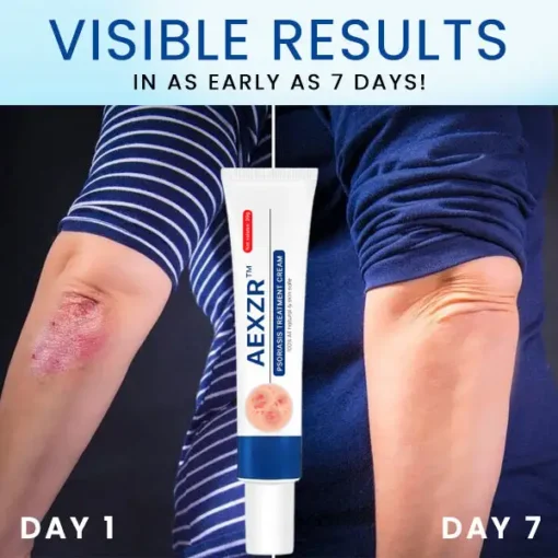 AEXZR™ Psoriasis Treatment Cream - Image 6