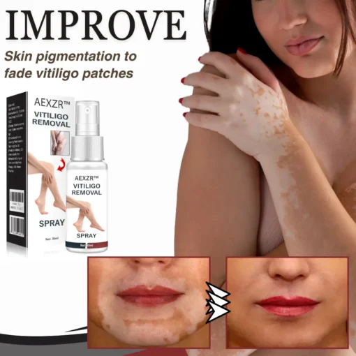 AEXZR™ Vitiligo Removal Spray - Image 3