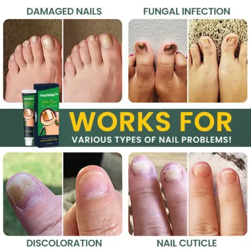 PANNIMA™ Nail Care Anti Fungal Cream - Image 5