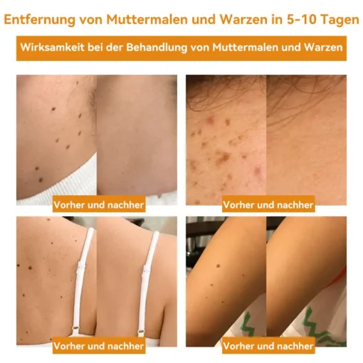 Vsoxa™ Bienengift Waren & Muttermalenfernung Creme - Image 13