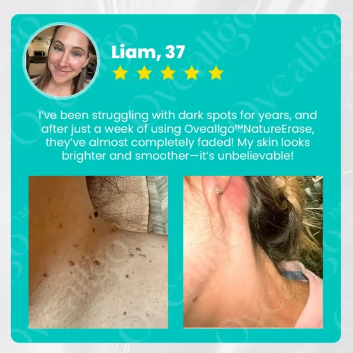 Oveallgo™ EX NatureErase Instant Mole & Spot Removal Gel